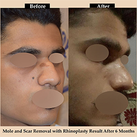 best rhinoplasty surgery in delhi