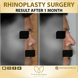 rhinoplasty in india | best nose job surgery