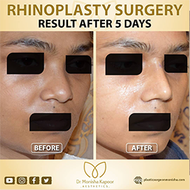 best clinic for rhinoplasty in india
