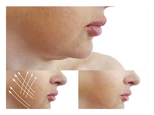 Face thinning liposuction