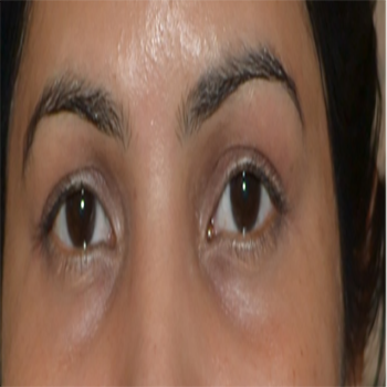 Best Eyelash Transplant in India