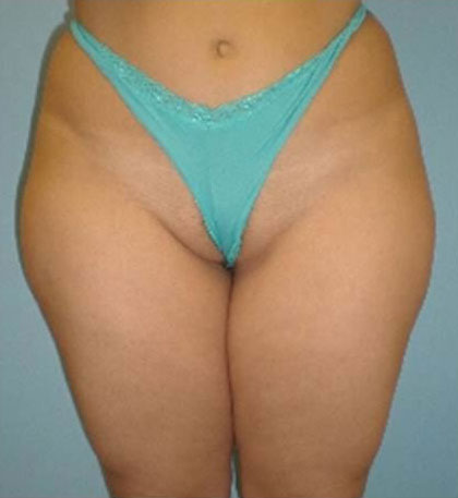 Liposuction surgery 