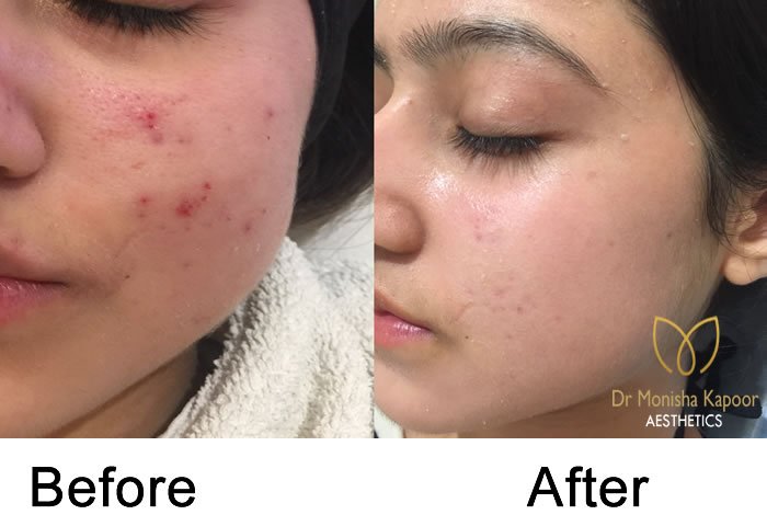 Acne Scars treatment in delhi