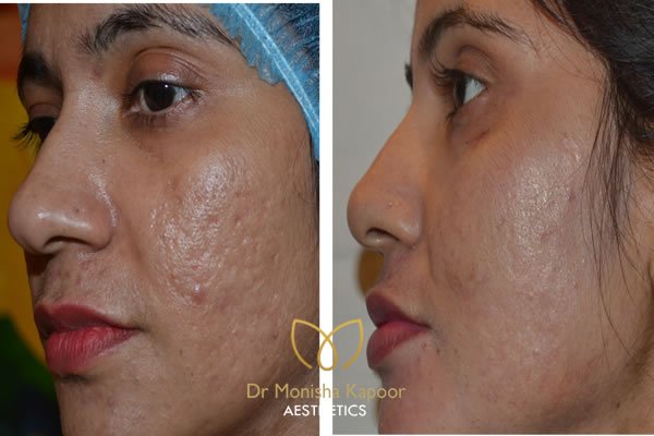 Acne Scars treatment in delhi