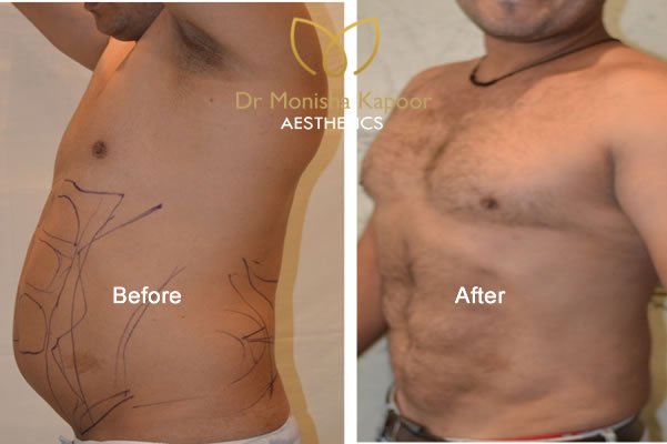 Liposuction in delhi