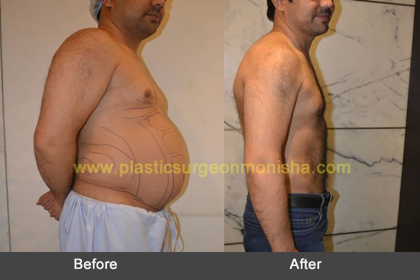 Liposuction & Six Pack ABS Surgery