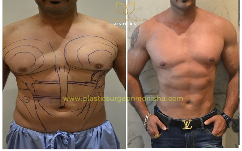 Liposuction and 6 Pack abs in delhi by Monisha Kapoor