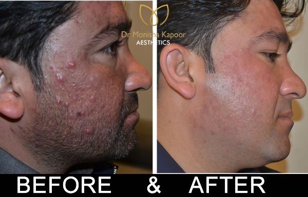 Acne Scars treatment in delhi