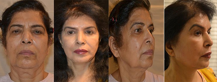 Facelift without surgery in delhi