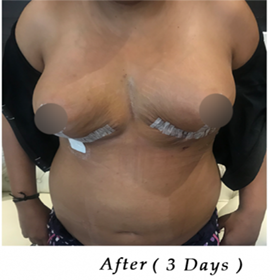 best Breast surgery in India