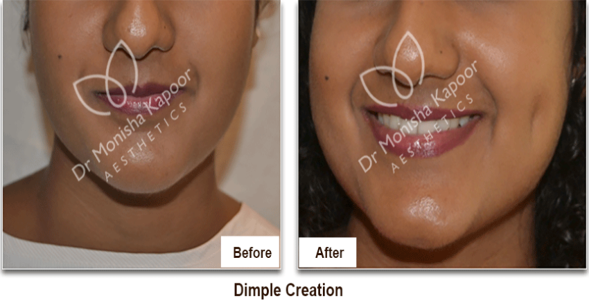 Dimple creation surgery