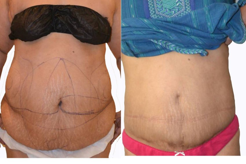 pregnancy tummy tuck before and after pregnancy tummy tuck before and after