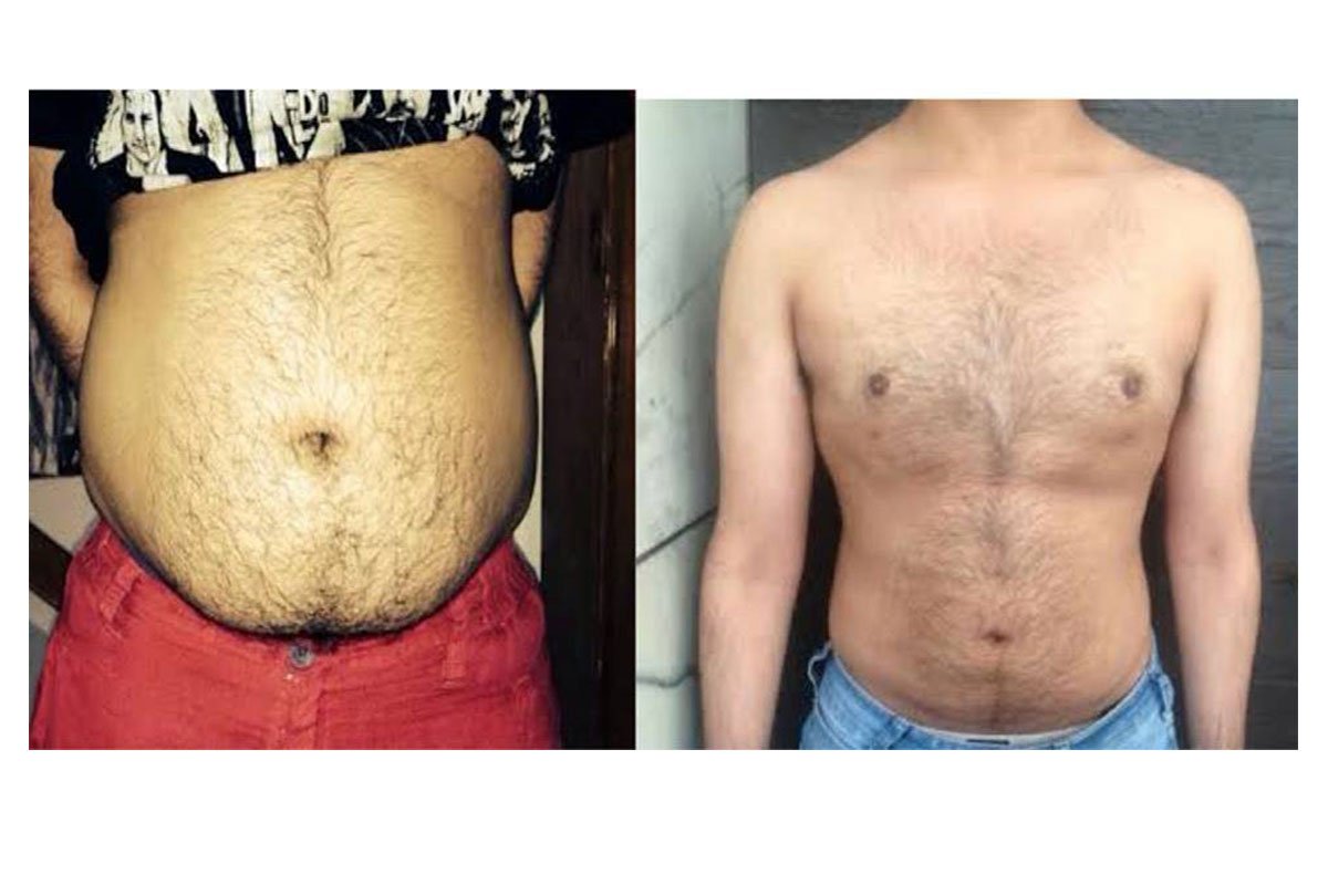tummy tuck before and after pics
