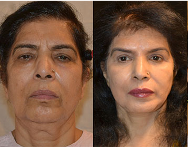 Best Cosmetic Plastic Surgeon Delhi Dr Monisha Kapoor India