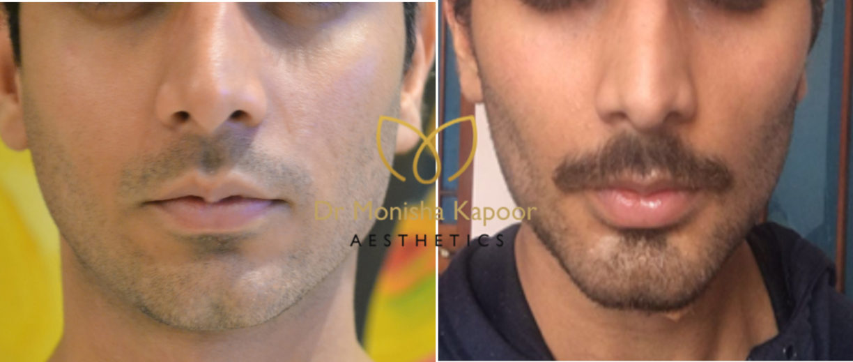 Best surgeon in delhi | how to remove buccal fat