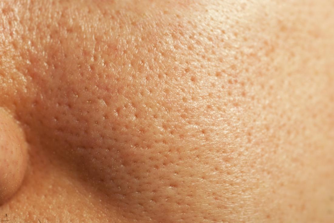 best medical treatment for open pores