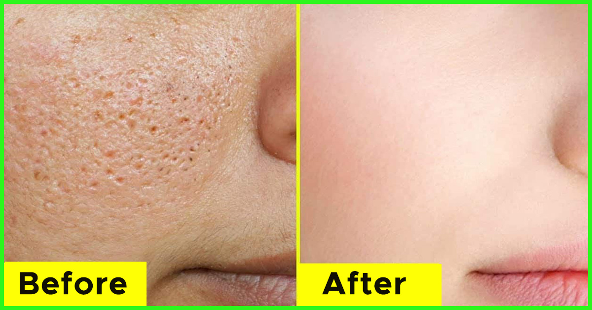 How to get rid of open pores naturally
