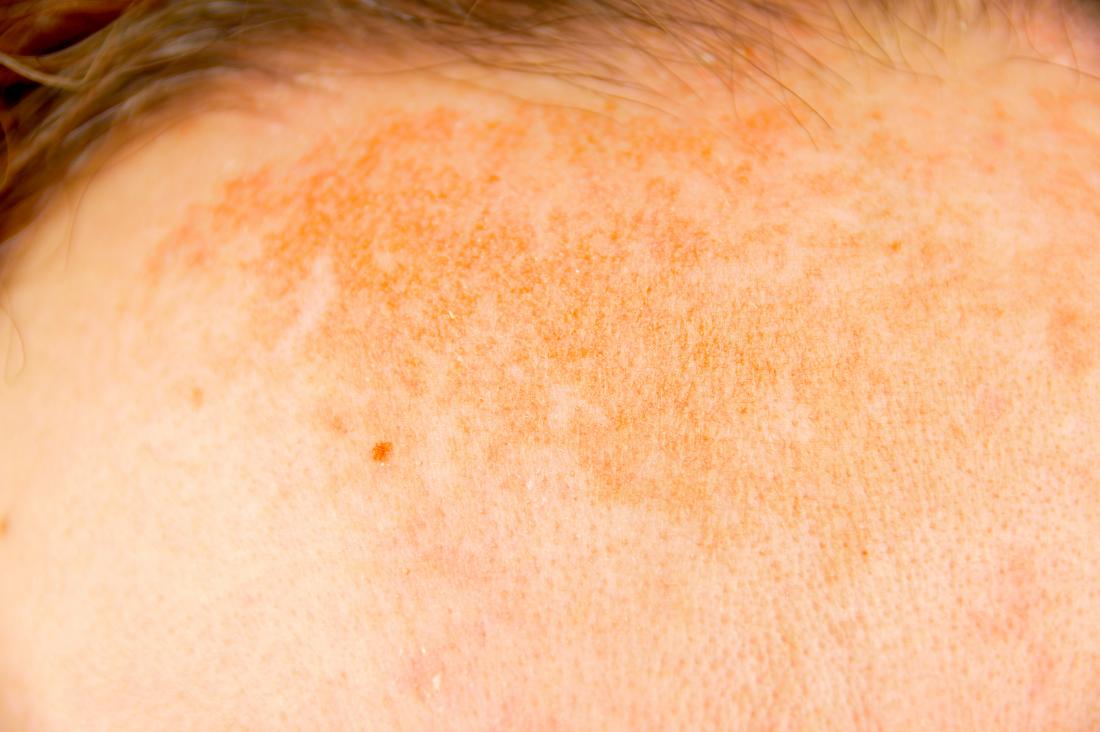 how to get rid of skin pigmentation naturally