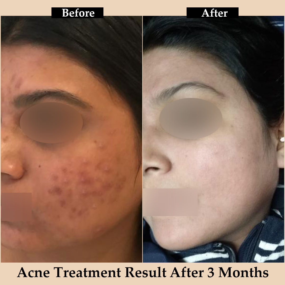 acne scar before and after