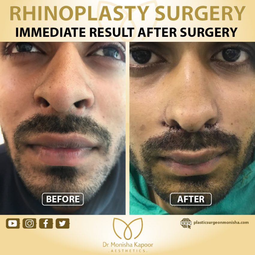 recovery time of rhinoplasty