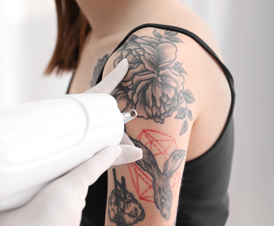 tattoo-removal-img