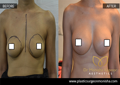 breast augmentation surgery cost in india