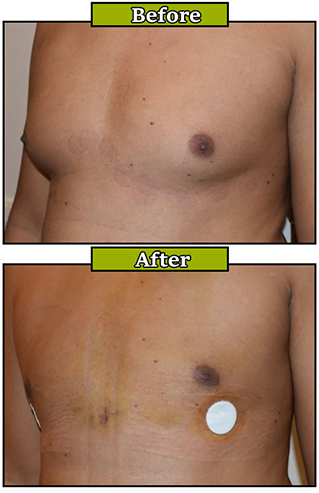 gynecomastia surgery near me