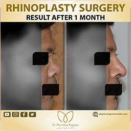 rhinoplasty in india | best nose job surgery