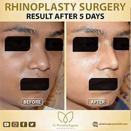 best clinic for rhinoplasty in india