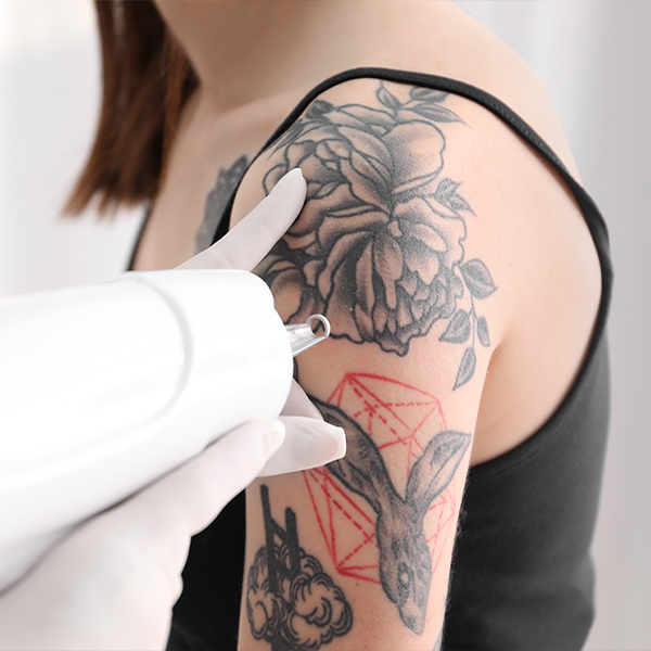 Tattoo Removal – Harley Plastic Surgery
