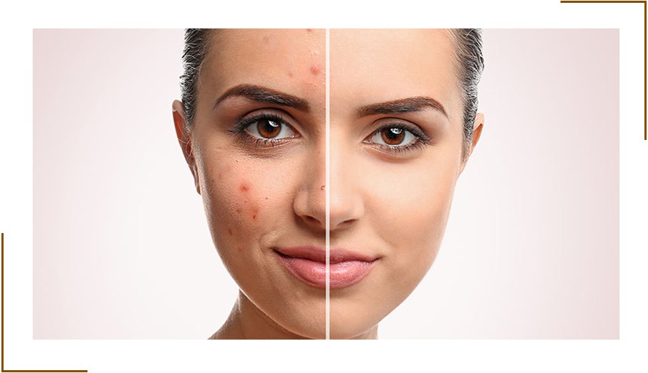 Acne Scars Treatment In Delhi Best Clinic For Acne Scar India