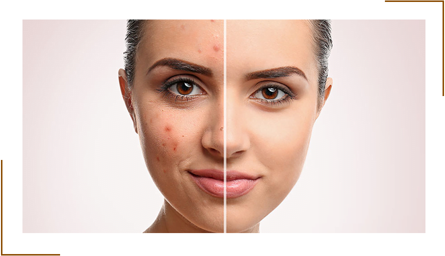 Acne Scars Treatment In Delhi Best Clinic For Acne Scar India