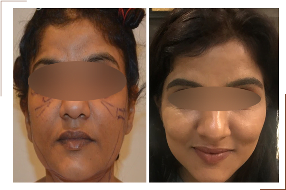 Thread Facelift