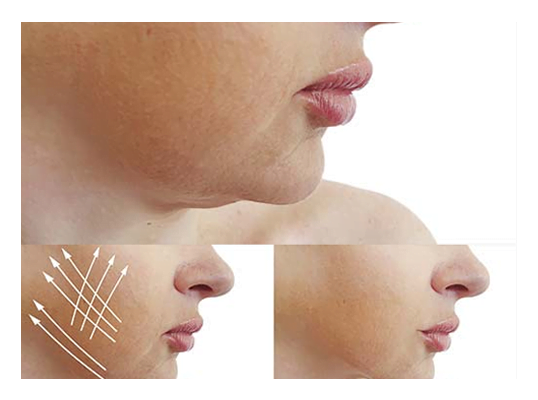 Face thinning liposuction