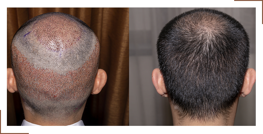 Hair Transplant