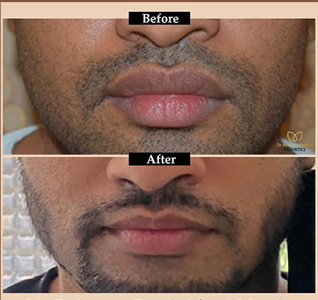 Lip Reduction