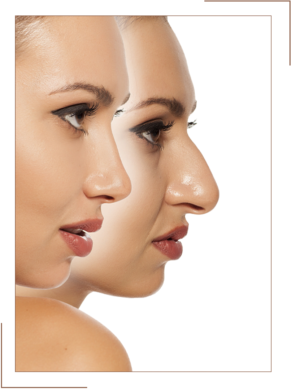 Recovery Rhinoplasty