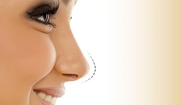 Best Rhinoplasty Surgery in Delhi