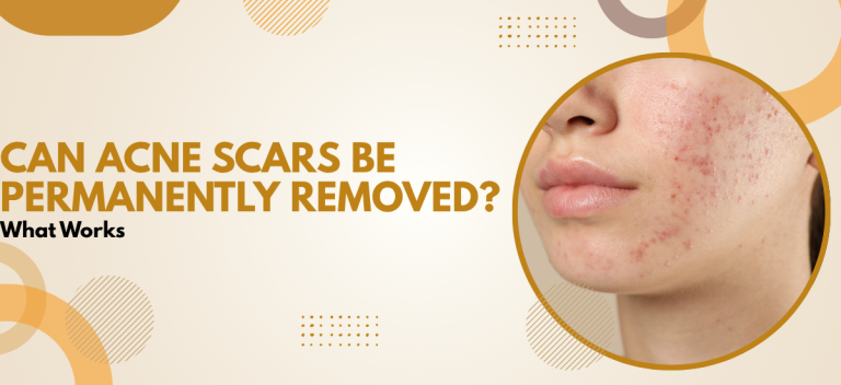 Can Acne Scars Be Permanently Removed? What Works?