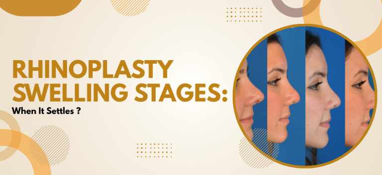 Rhinoplasty Swelling Stages: When It Settles?