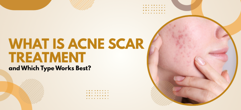 What Is Acne Scar Treatment and Which Type Works Best?