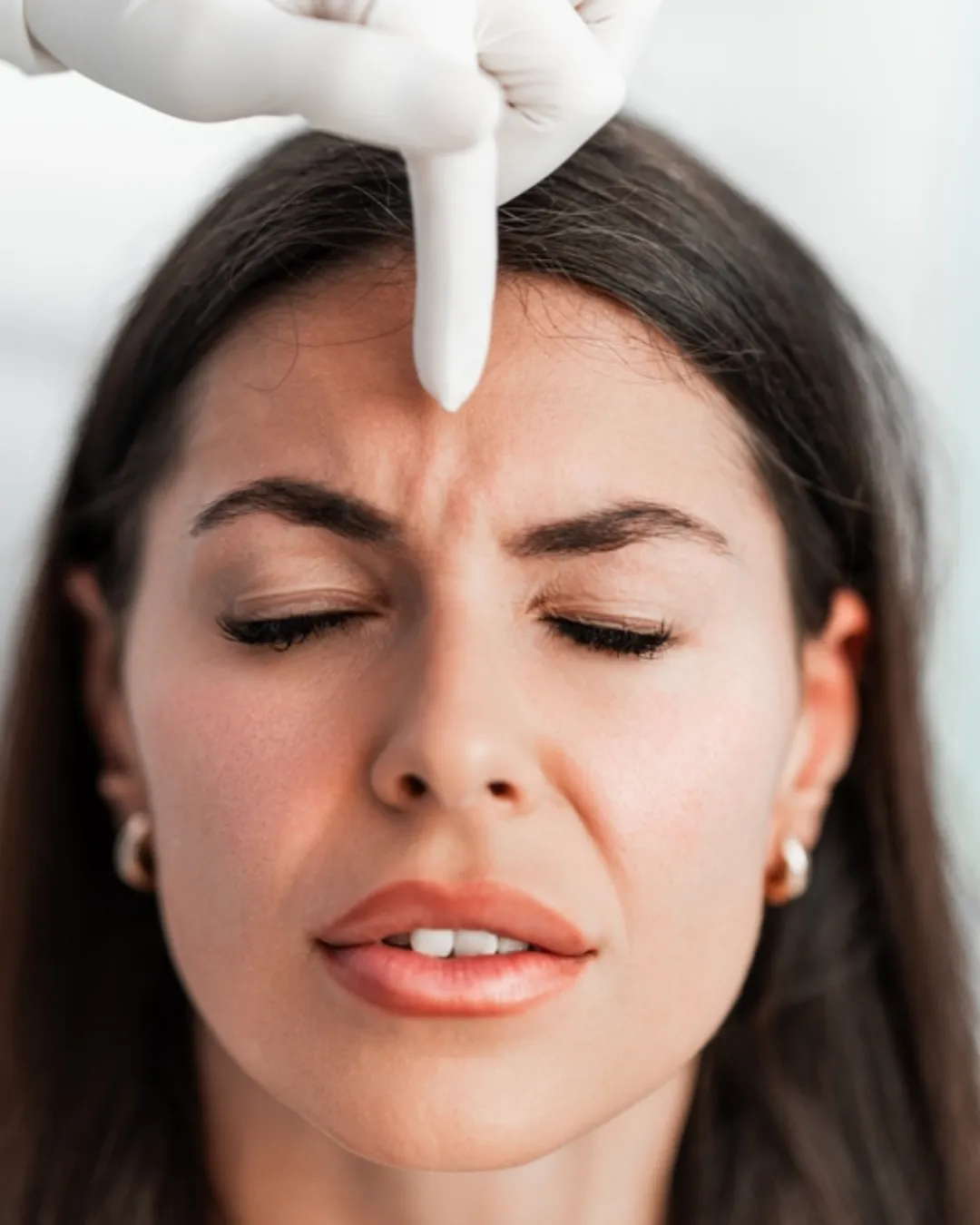 Facial Bone Contouring with Fillers