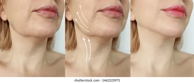 What is Face Bone Change Treatment