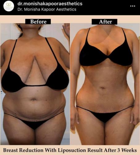 Breast Reduction with Liposuction Result After 3 Weeks