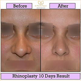 rhinoplasty-img11