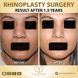 rhinoplasty-img3