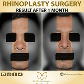 rhinoplasty-img5