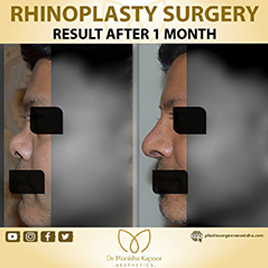 rhinoplasty-img6