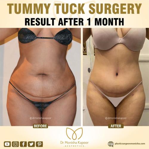 Tummy Tuck Surgery Result After 1 Month
